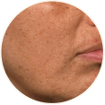 Combination Skin