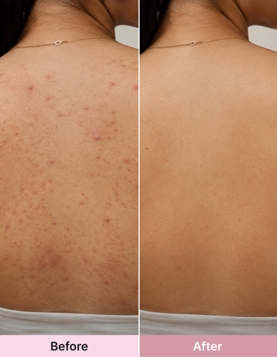 BacneClear™ Body Acne & Spot Corrector Spray