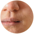 Dry Skin