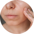 Oily Skin