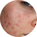 Active Acne Routine
