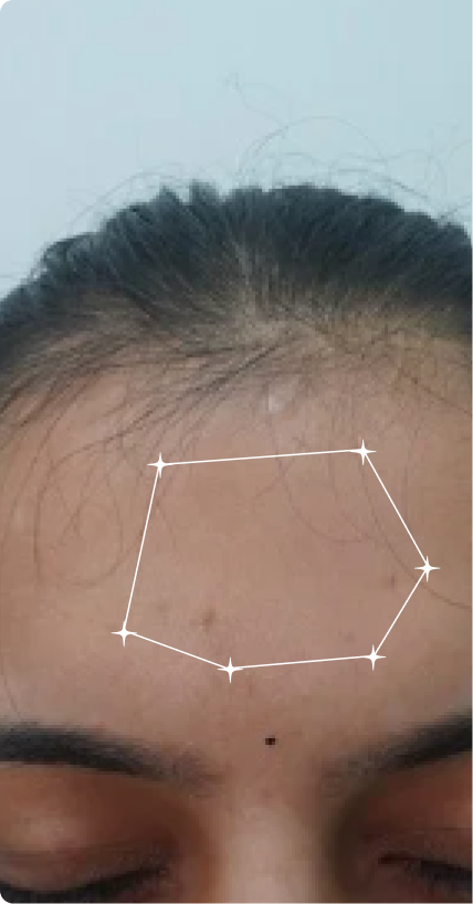 Before — Oily Skin 