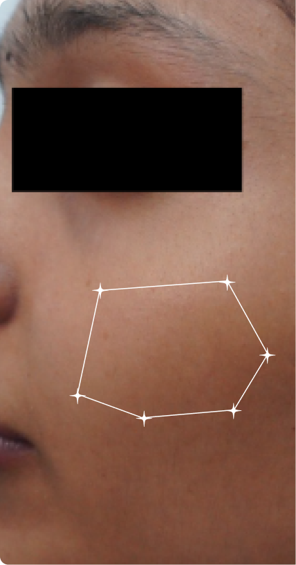 Before — Sensitive Skin 