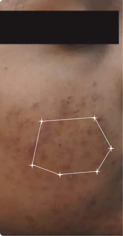 Before — Dark Spots