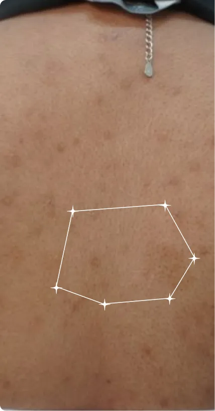 Before — Back Acne