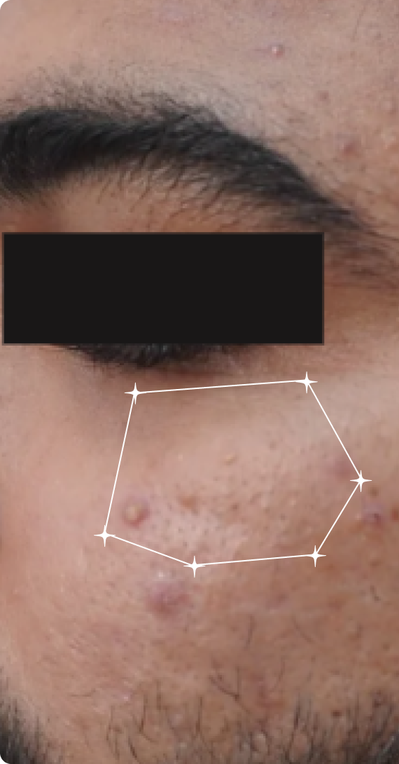 Before — Oily Skin 