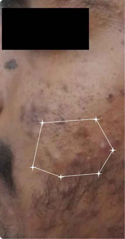 Before — Post-Acne Marks