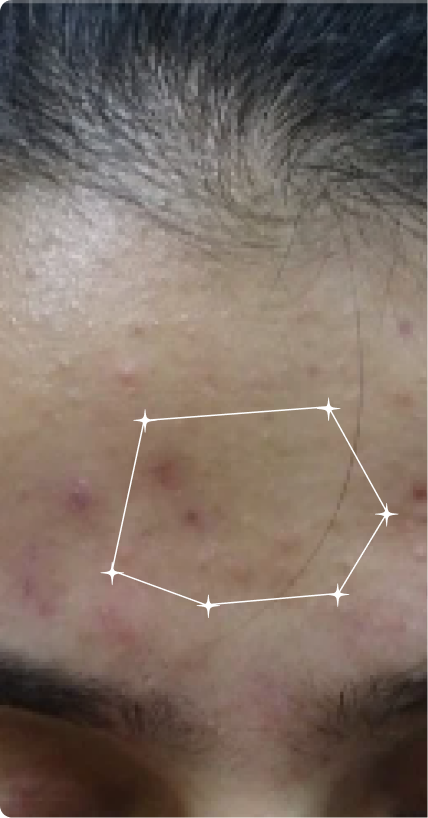 Before — Pore Congestion