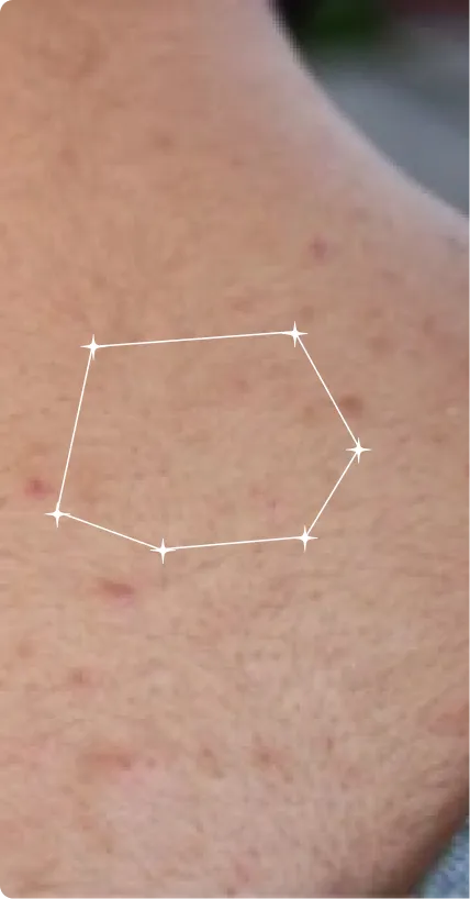 Before — Post-Acne Marks