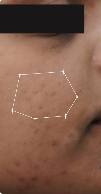 Before — Melasma