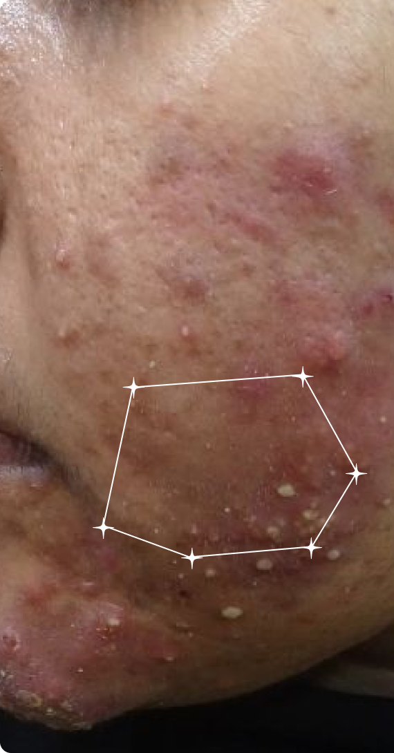 Before — Post-Acne Marks