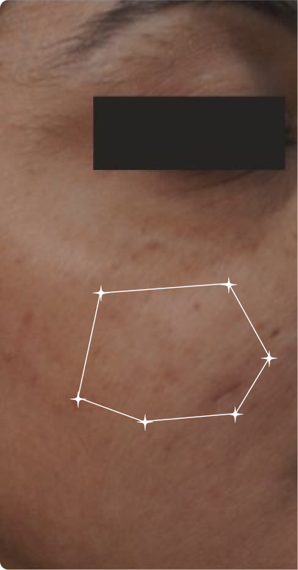 Before — Sensitive Skin