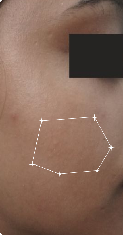 Before — Pigmentation