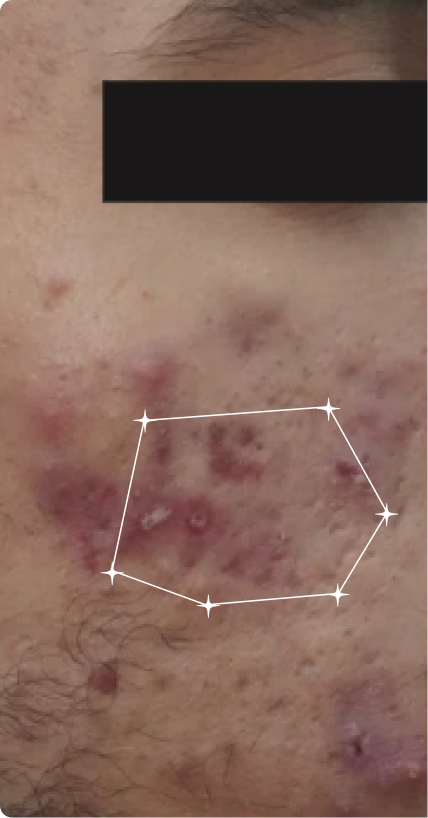 Before — Acne