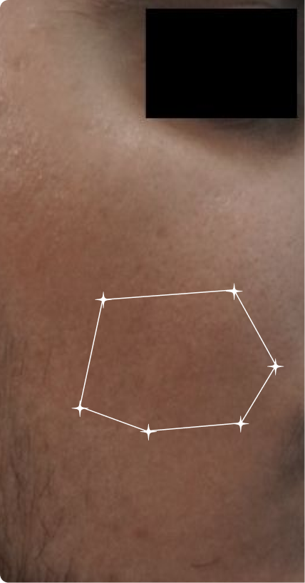 Before — Sensitive Skin 