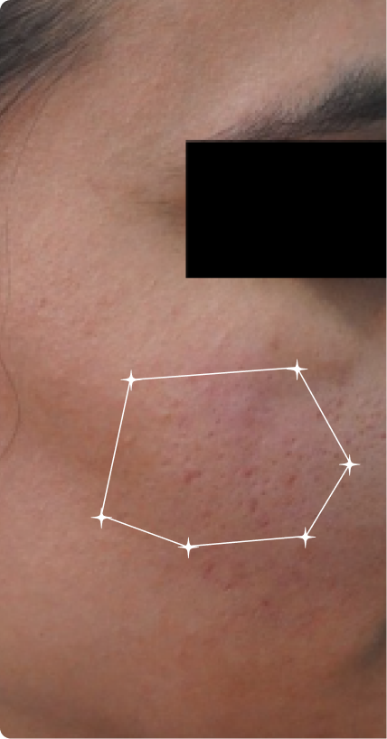 Before — Acne