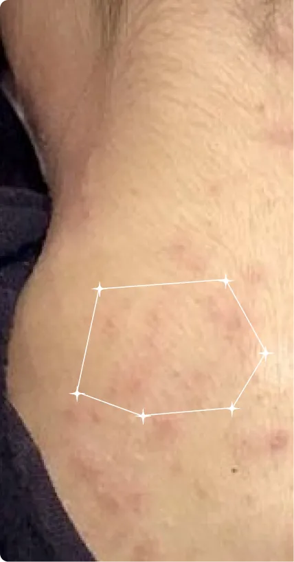 Before — Body Acne