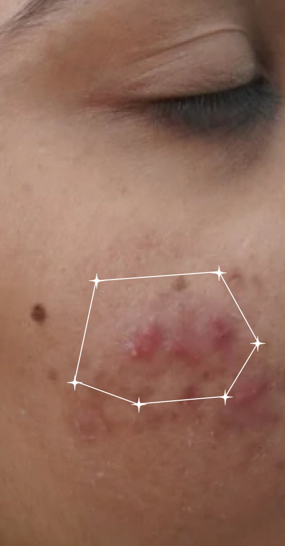 Before — Acne