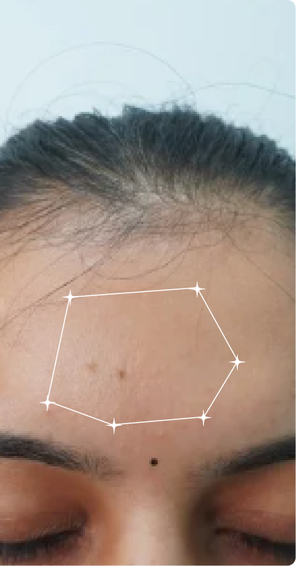 After — Oily Skin 