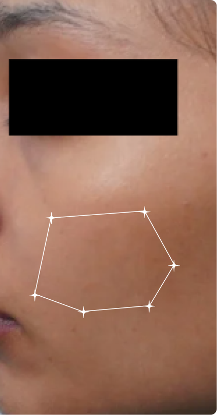 After — Sensitive Skin 