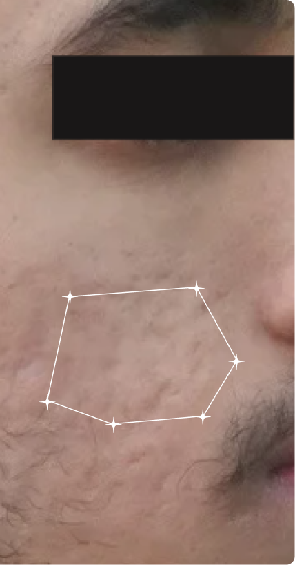 After — Acne
