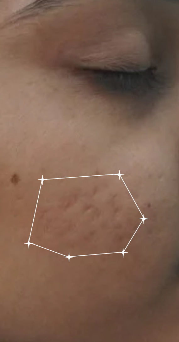 After — Acne