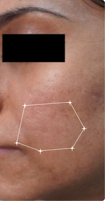 After — Dull Skin