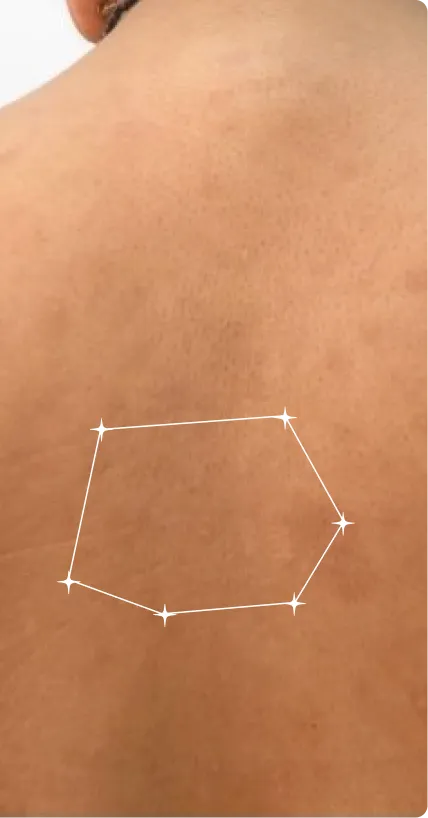 After — Back Acne
