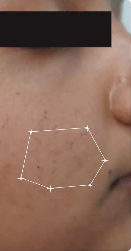 After — Dark Spots