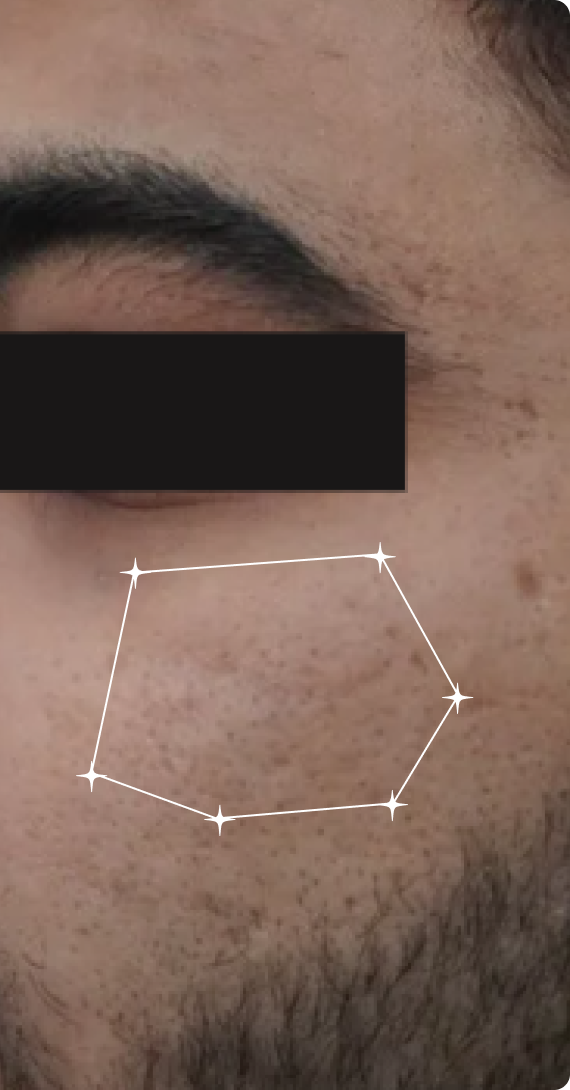 After — Oily Skin 
