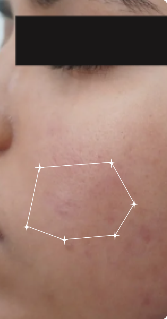 After — Sensitive Skin
