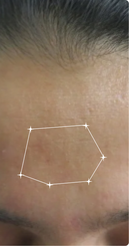 After — Pore Congestion