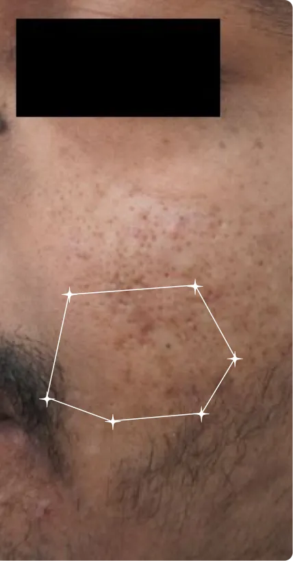 After — Post-Acne Marks