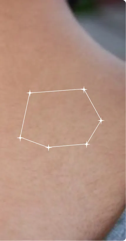 After — Post-Acne Marks