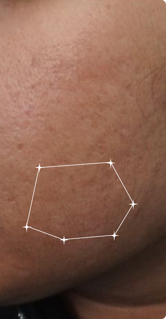 After — Post-Acne Marks