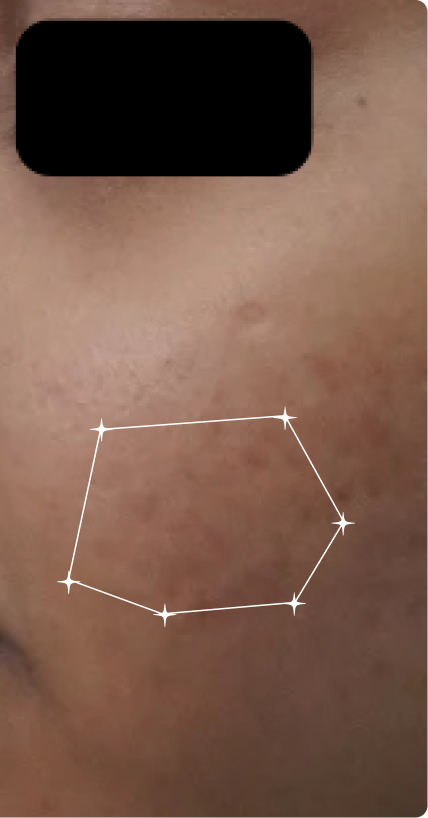 After — Sensitive-Oily