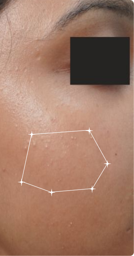 After — Pigmentation