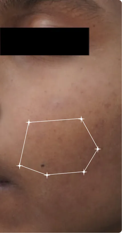After — Pigmentation