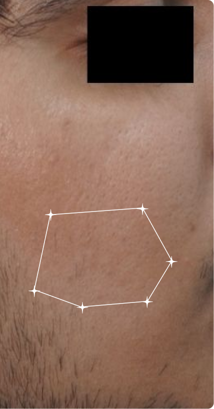 After — Sensitive Skin 