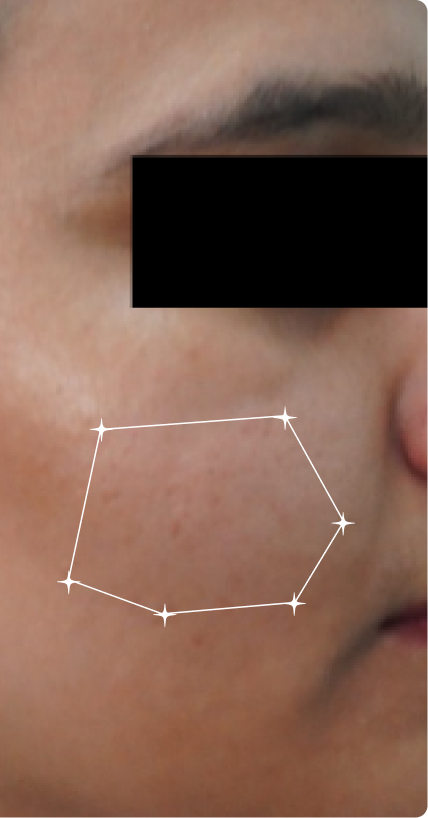 After — Acne