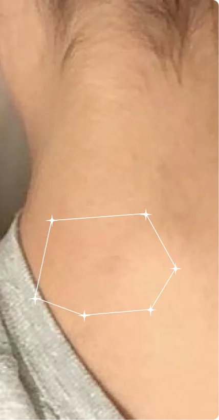 After — Body Acne